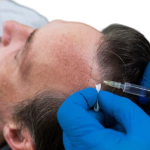 Trapianto di capelli uomo